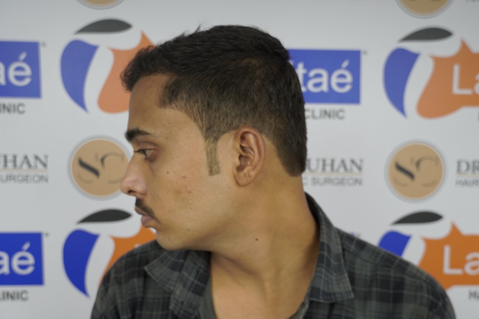Ashis Yadav After Hair Transplant